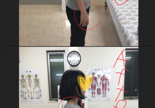 磐田　肩こり　姿勢矯正　Before　After