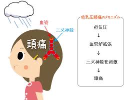 低気圧の頭痛！！３つの対策！！